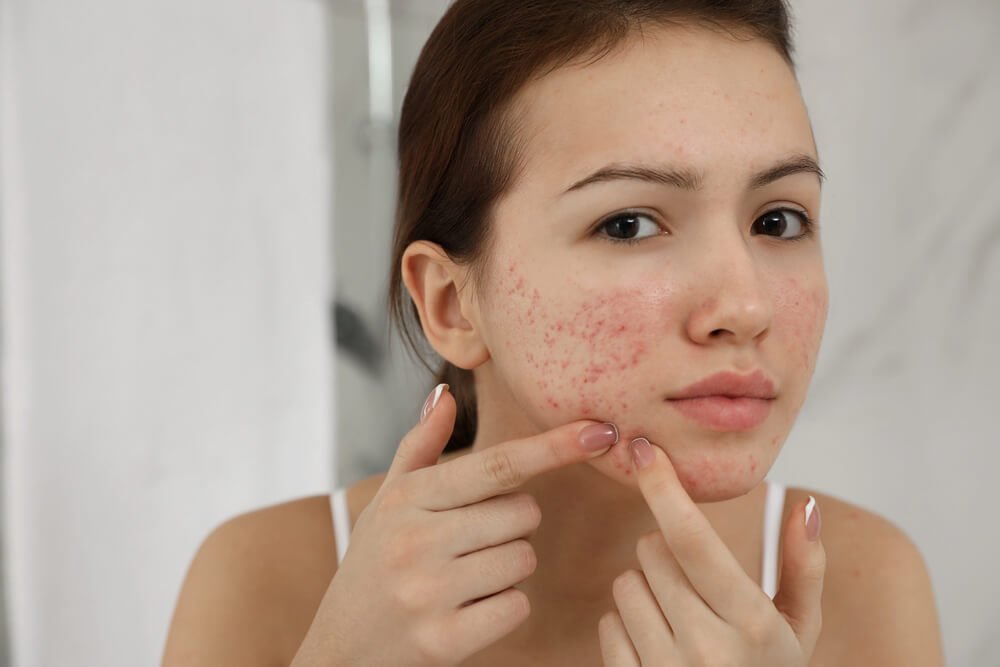 how to be confident with acne
