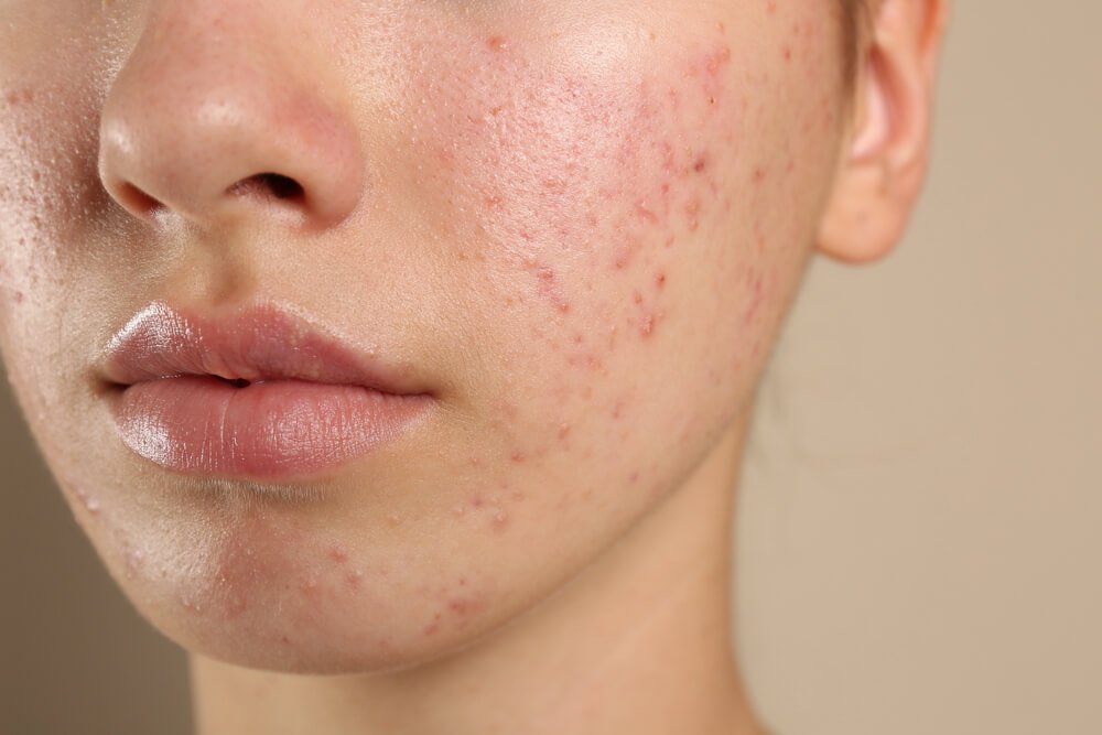 how to be confident with acne 
