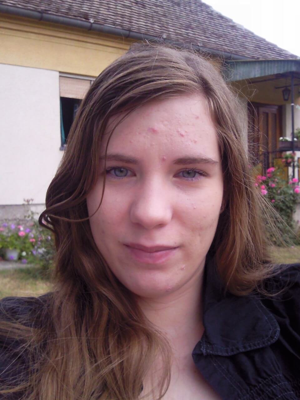 how to be confident with acne