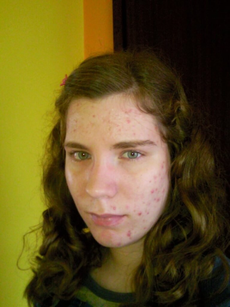 how to be confident with acne 