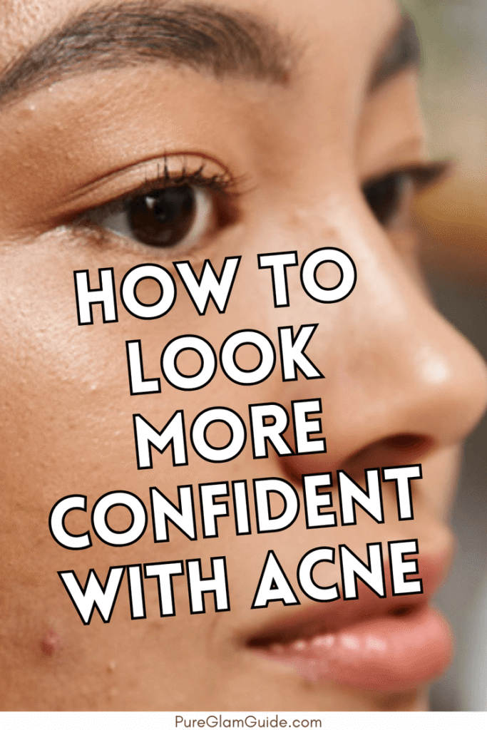 how to look more confident with acne 